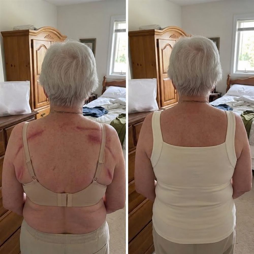 Before and after, back view: red strap marks from a bra, then wide straps lying flat in a cream tank