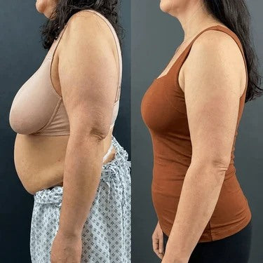 Side view of the same woman before and after: in her bra her bust sits low above a rounded middle; in a fitted tank her bust is lifted and she looks slimmer